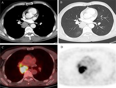 Pseudo-progression with osimertinib after definitive chemoradiation in unresectable epidermal growth factor receptor mutation positive of stage III non-small cell lung cancer: A case report